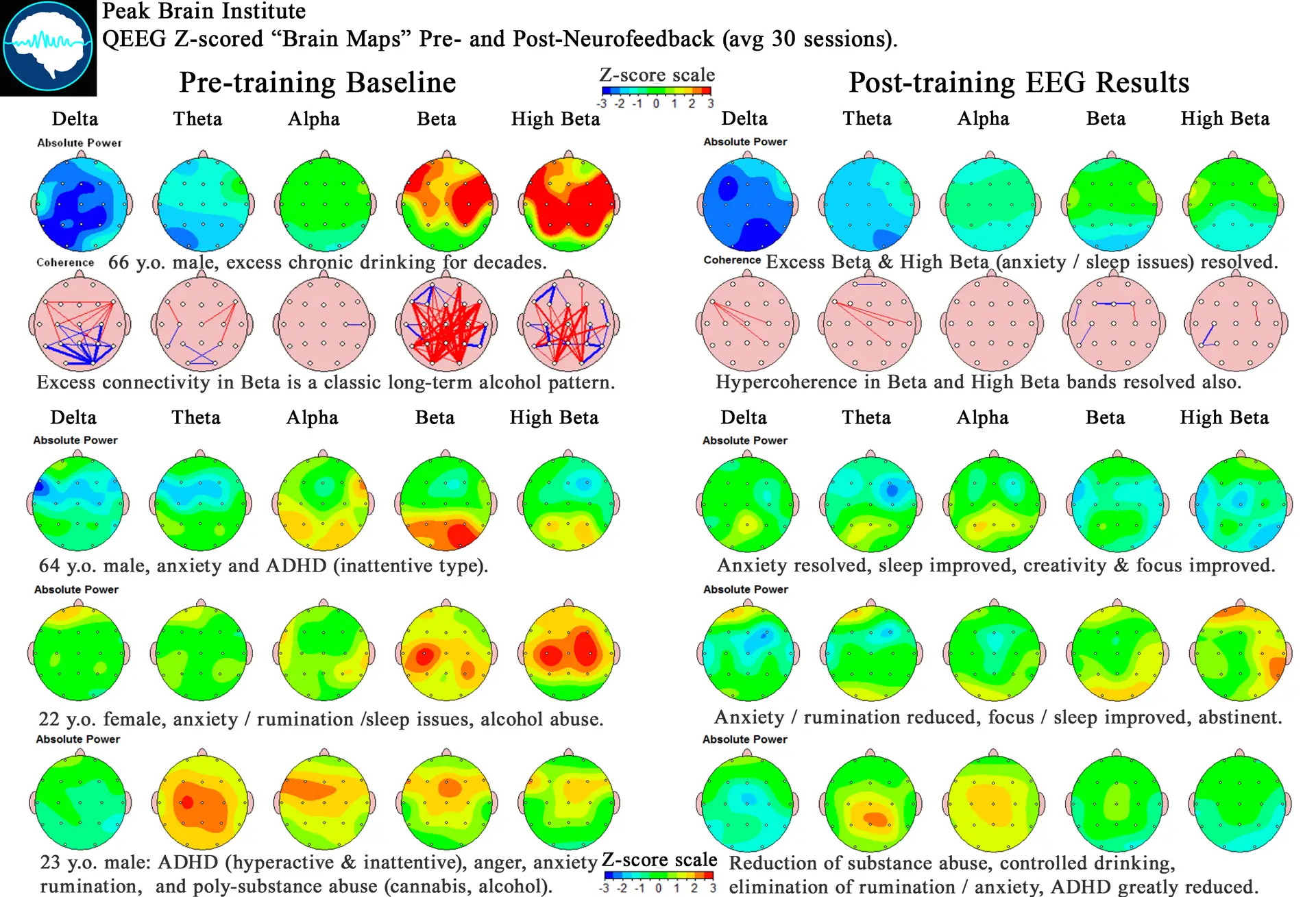 Före och efter QEEG hjärnkartor som visar neurofeedback-resultat
